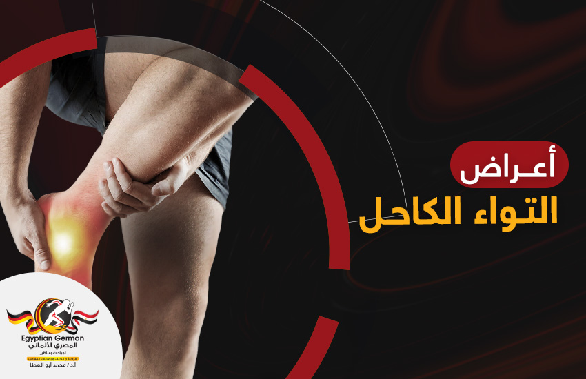 ما أعراض التواء الكاحل؟ وكيف يُمكن تخفيفها؟ 