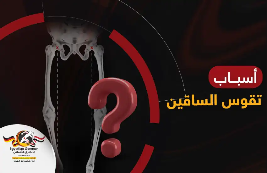 كل ما تريد معرفته عن أسباب تقوس الساقين