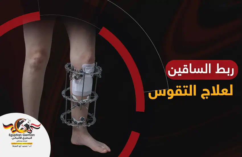 هل ربط الساقين لعلاج التقوس خيار فعال؟ 